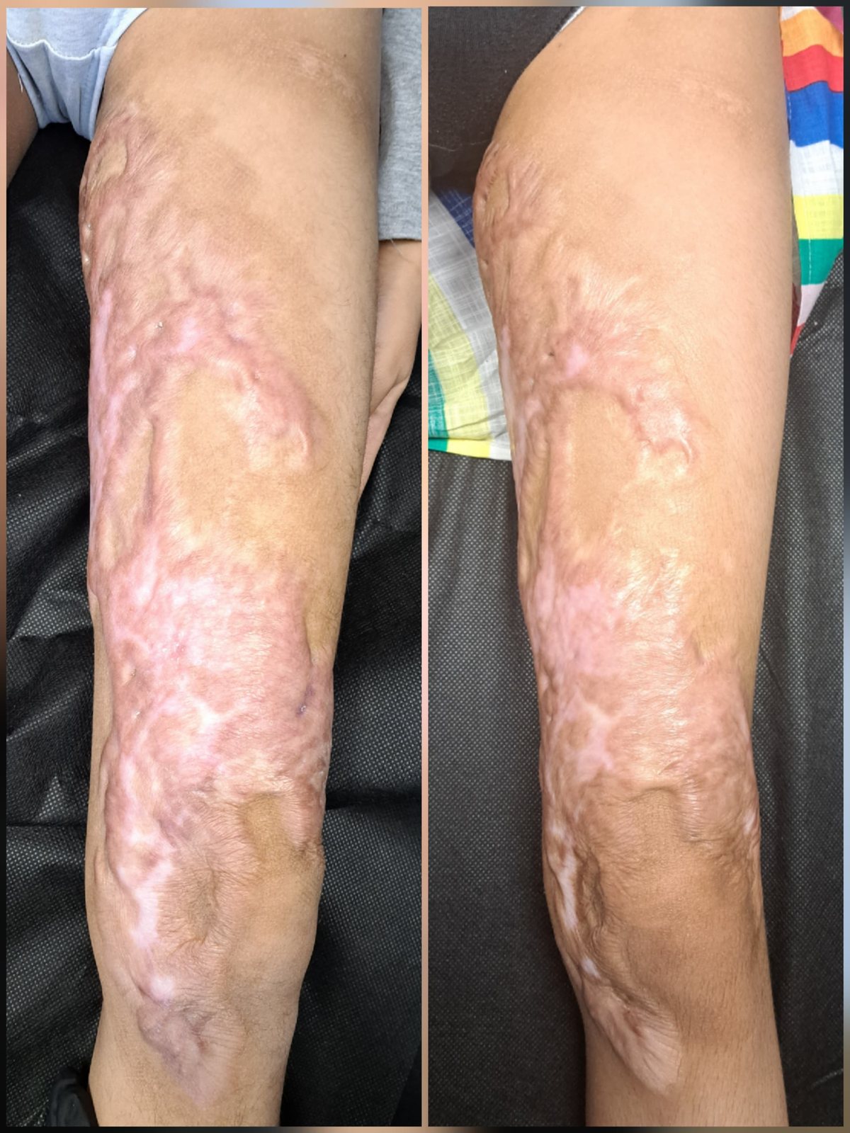 Scar therapy